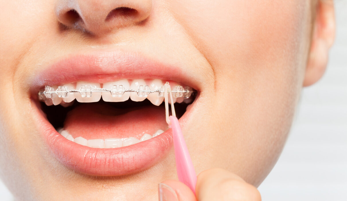 When Rubber Bands are Used with Traditional Metal Braces or Clear Ceramic Braces | Elastics and Orthodontic Consultations in Melbourne
