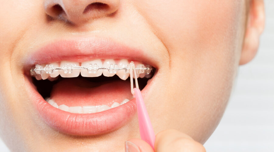 When Rubber Bands are Used with Traditional Metal Braces or Clear Ceramic Braces | Elastics and Orthodontic Consultations in Melbourne