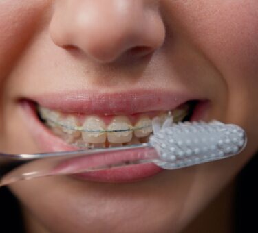 Manual vs Electric Toothbrushes for People with Braces | Oral Hygiene Tips for Adult Braces & Teen Braces in Melbourne | Metal vs Ceramic Braces Tips