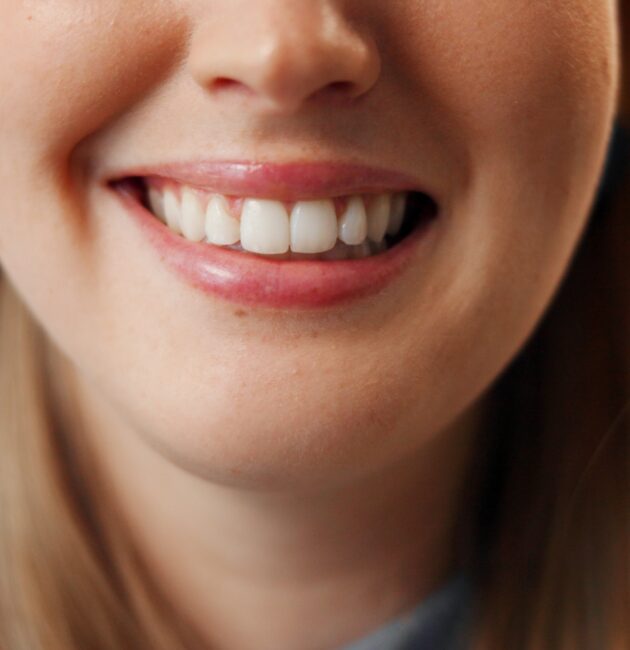 Professional Teeth Whitening vs Home Whitening Kits | Best Teeth Whitening Products | For Tooth Stains & Discolouration | Cosmetic Dentist In Darwin