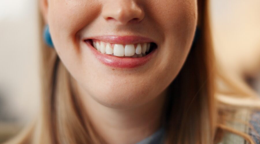 Professional Teeth Whitening vs Home Whitening Kits | Best Teeth Whitening Products | For Tooth Stains & Discolouration | Cosmetic Dentist In Darwin