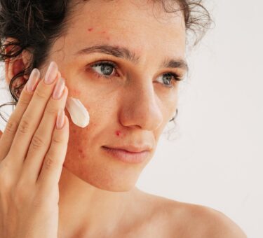 Adult Acne & Fine Lines | How To Treat Both With RoC Derm Correxion | Hyaluronic Acid & Retinol For Sensitive Skin
