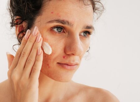 Adult Acne & Fine Lines | How To Treat Both With RoC Derm Correxion | Hyaluronic Acid & Retinol For Sensitive Skin