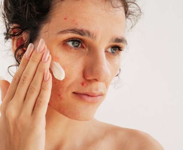 Adult Acne & Fine Lines | How To Treat Both With RoC Derm Correxion | Hyaluronic Acid & Retinol For Sensitive Skin