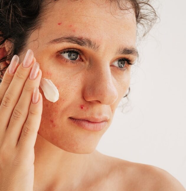 Adult Acne & Fine Lines | How To Treat Both With RoC Derm Correxion | Hyaluronic Acid & Retinol For Sensitive Skin
