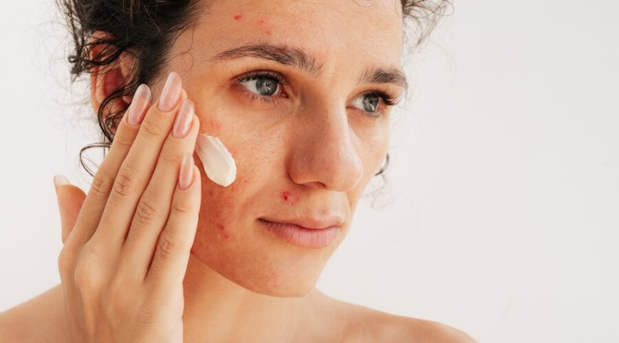 Adult Acne & Fine Lines | How To Treat Both With RoC Derm Correxion | Hyaluronic Acid & Retinol For Sensitive Skin