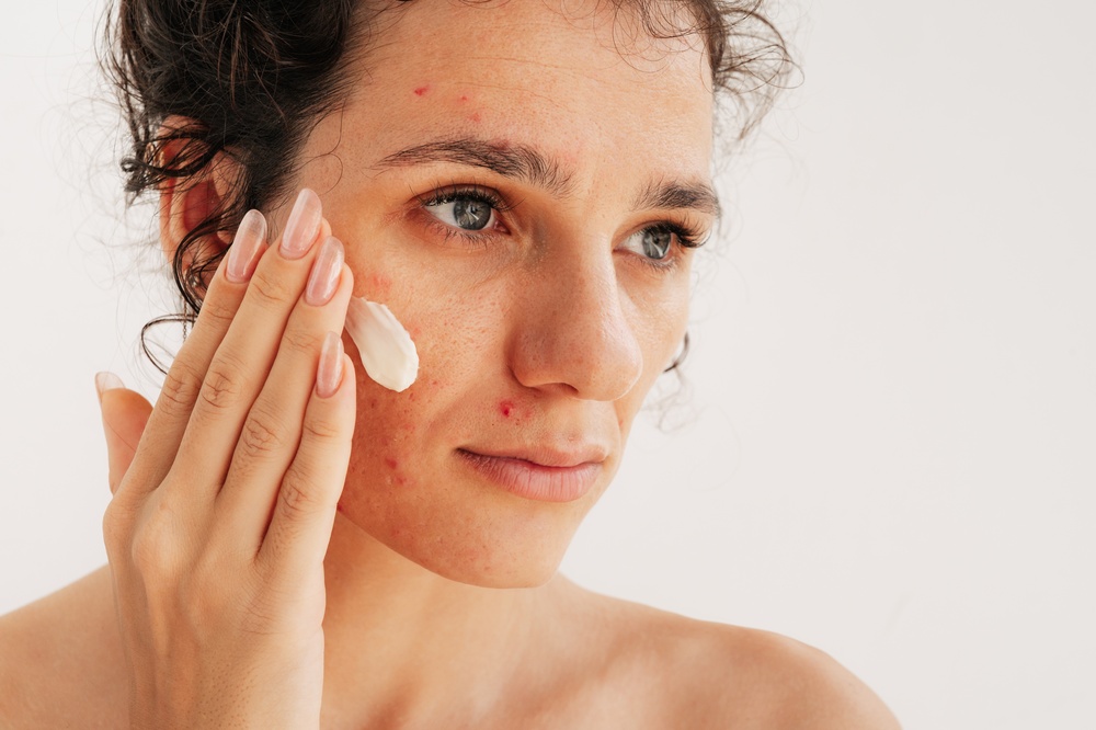 Adult Acne & Fine Lines | How To Treat Both With RoC Derm Correxion | Hyaluronic Acid & Retinol For Sensitive Skin