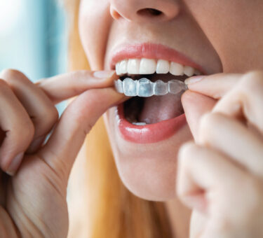 Bride preparing for her wedding while considering adult braces, aligner therapy and Invisalign for a straighter smile.