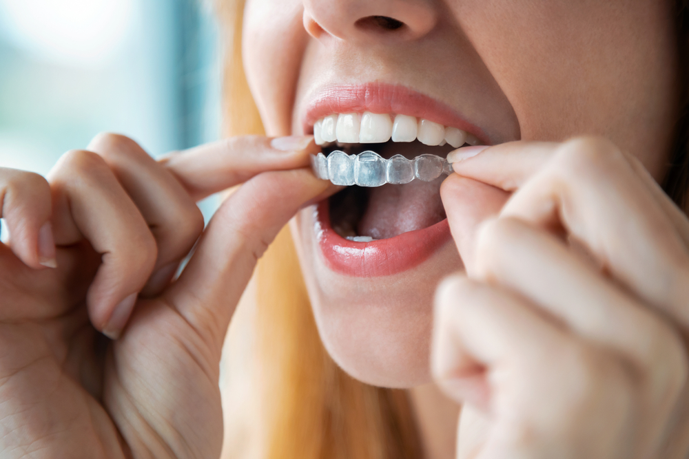 Bride preparing for her wedding while considering adult braces, aligner therapy and Invisalign for a straighter smile.